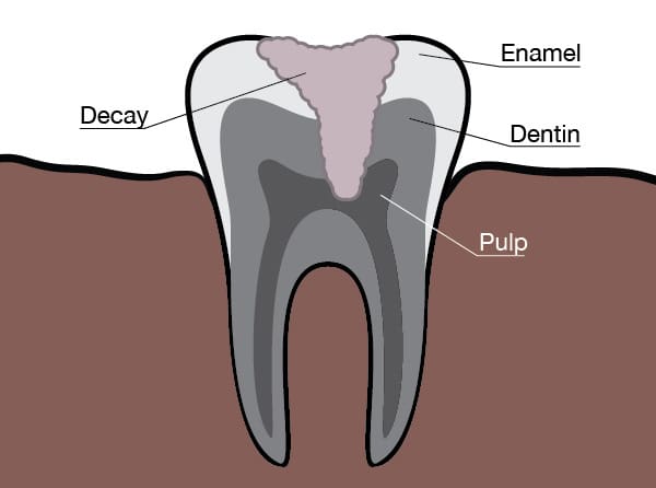 Graphic of sensitive teeth caused by decay