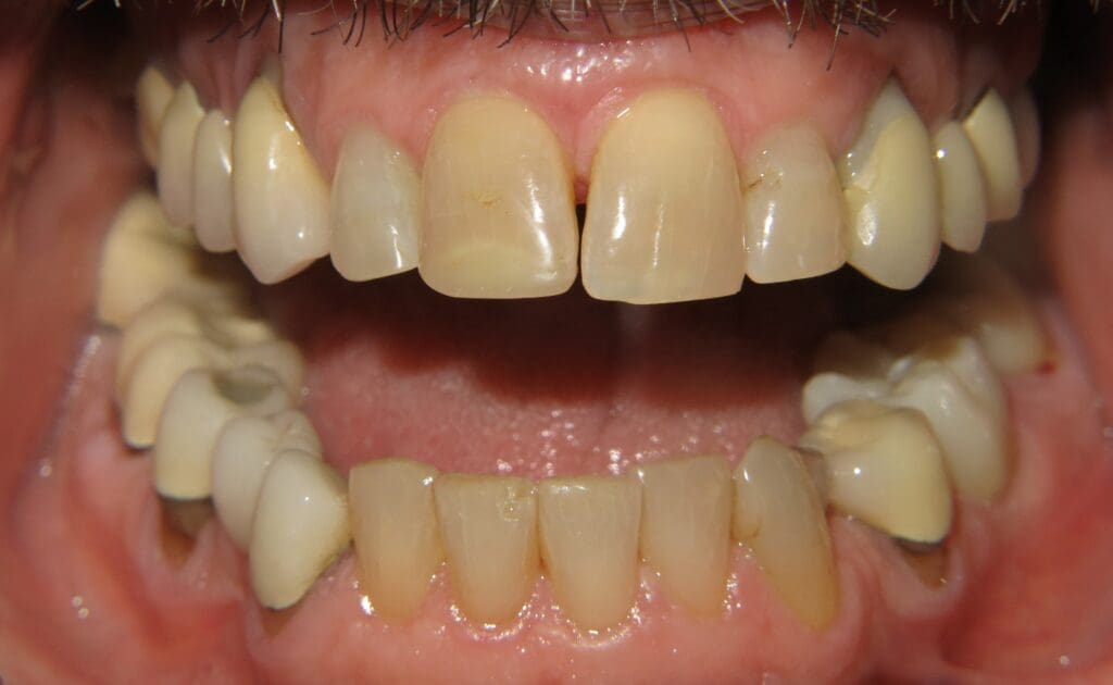 A Redmond Signature Dentistry "before" cosmetic dentistry work